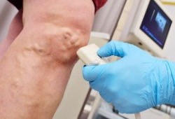 УЗИ вен нижних конечностей
