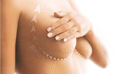 Маммопластика