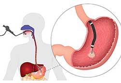 Эзофагогастродуоденоскопия (гастроскопия, или ЭГДС)