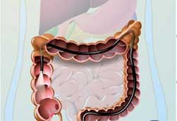 Колоноскопия