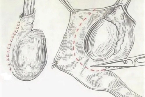 Водянка яичка (гидроцеле)